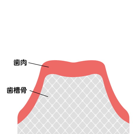 1次手術。長野県松本市女鳥羽の歯科・歯医者でインプラント治療なら平沼歯科医院へご相談を