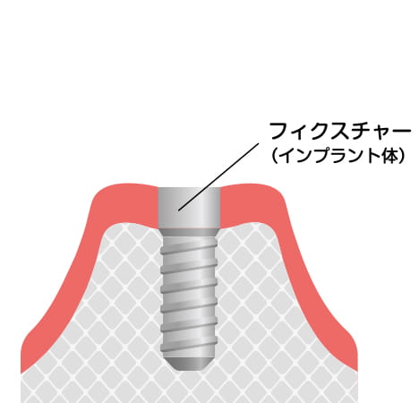 2次手術。長野県松本市女鳥羽の歯科・歯医者でインプラント治療なら平沼歯科医院へご相談を