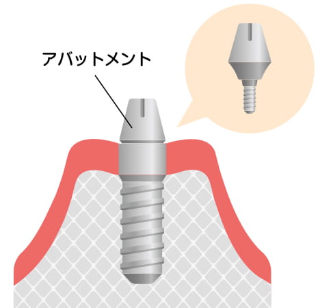 型取り。長野県松本市女鳥羽の歯科・歯医者でインプラント治療なら平沼歯科医院へご相談を