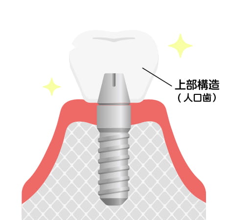人工歯を装着。長野県松本市女鳥羽の歯科・歯医者でインプラント治療なら平沼歯科医院へご相談を
