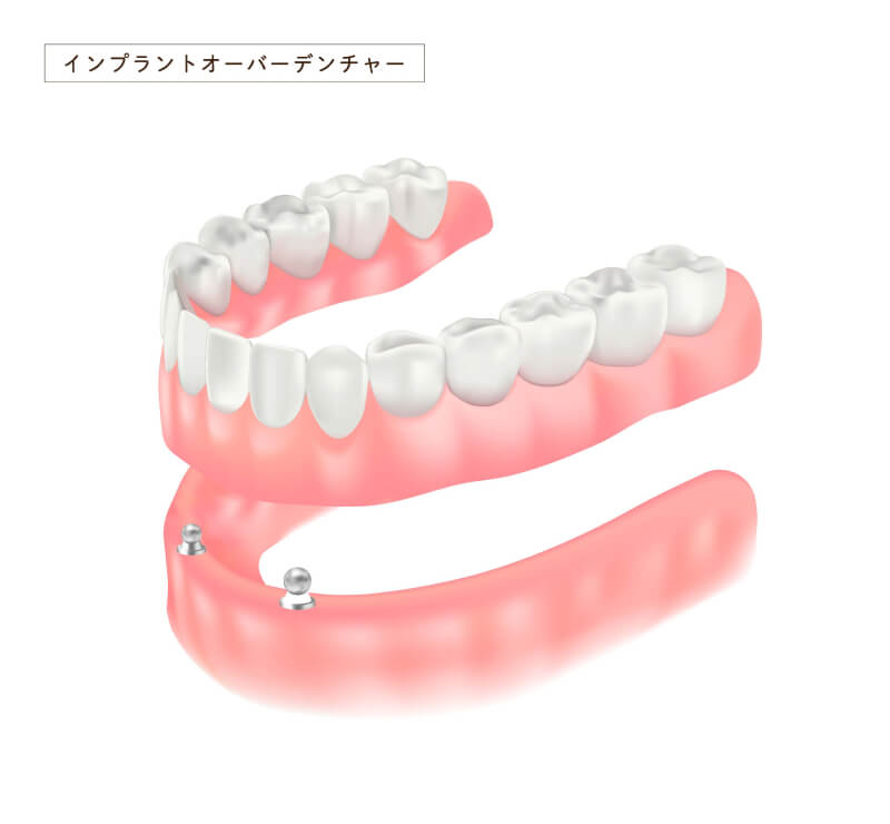 インプラントオーバーデンチャーのメリット。長野県松本市女鳥羽の歯科・歯医者でインプラント治療なら平沼歯科医院へご相談を