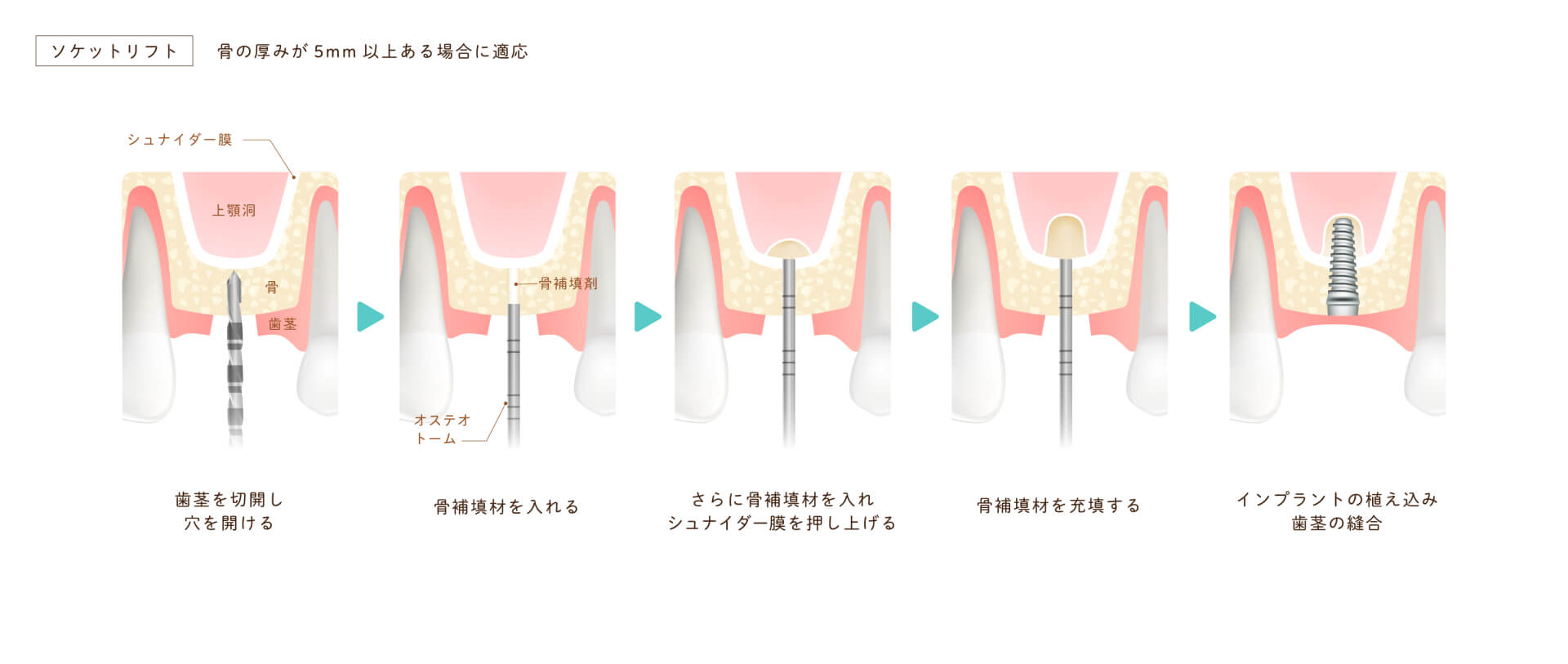 ソケットリフト。長野県松本市女鳥羽の歯科・歯医者でインプラント治療なら平沼歯科医院へご相談を