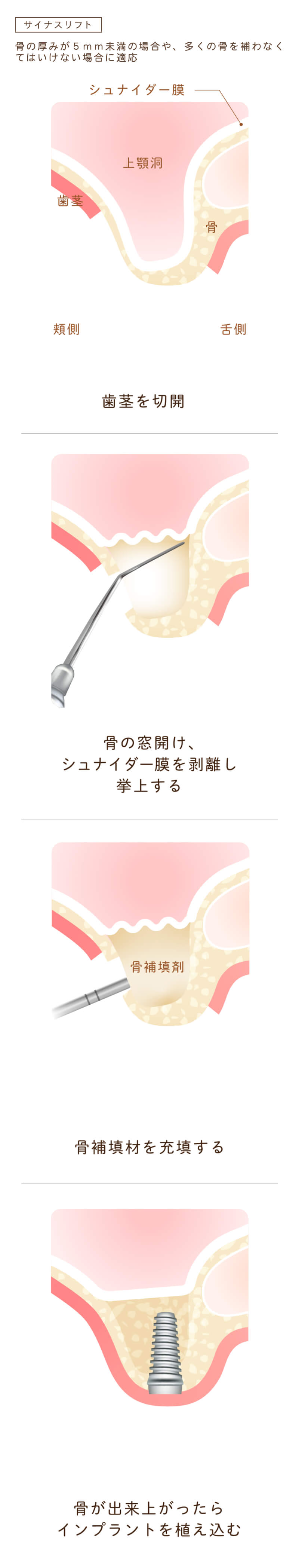 サイナスリフトsp。長野県松本市女鳥羽の歯科・歯医者でインプラント治療なら平沼歯科医院へご相談を