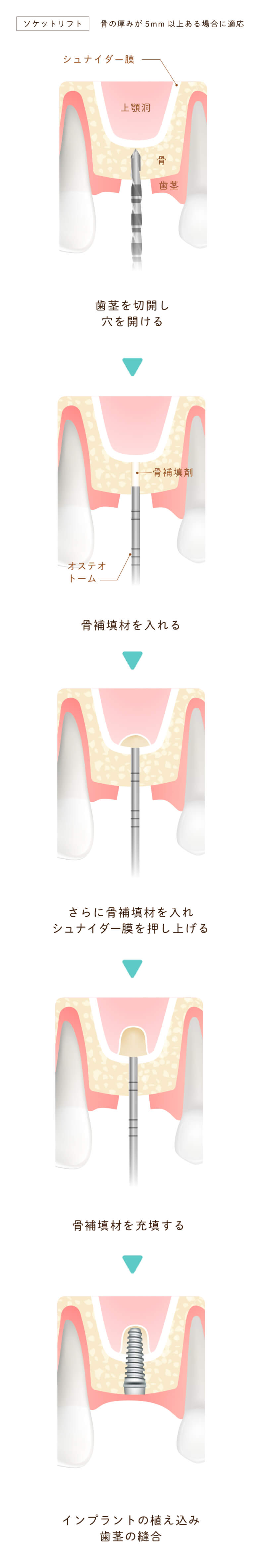 ソケットリフトsp。長野県松本市女鳥羽の歯科・歯医者でインプラント治療なら平沼歯科医院へご相談を