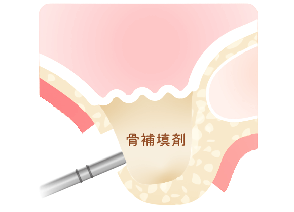 骨がない方も相談してください！骨造成という方法もあります。長野県松本市女鳥羽の歯科・歯医者でインプラント治療なら平沼歯科医院へご相談を