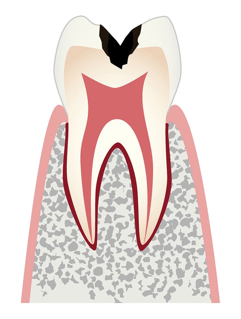歯の内部（象牙質）まで進行した虫歯のイラスト