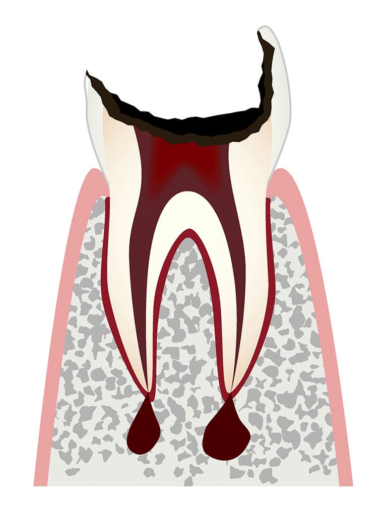 歯根まで進行した虫歯のイラスト