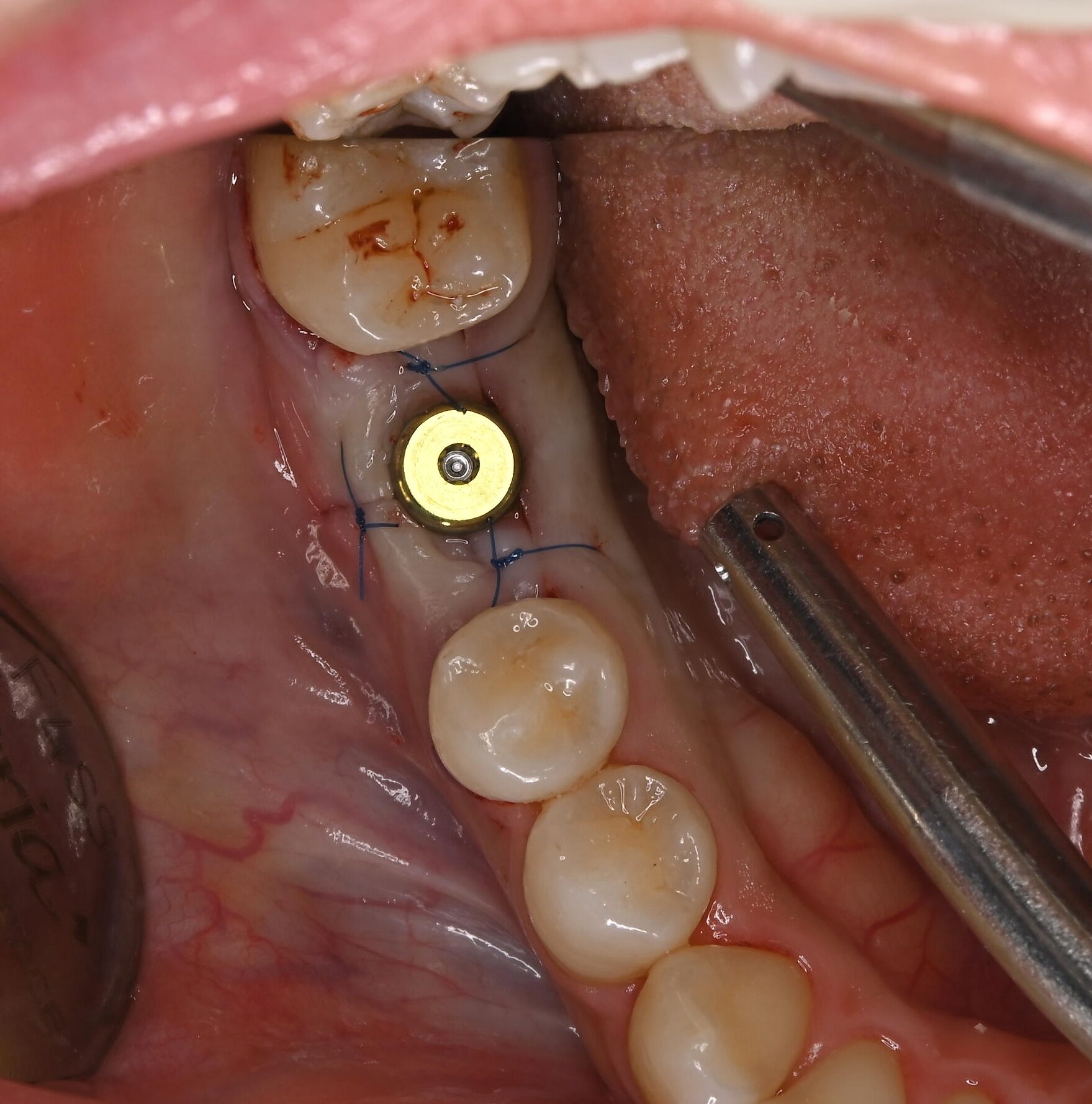 インプラントを埋入するのと同時にヒーリングキャップを取り付けました。