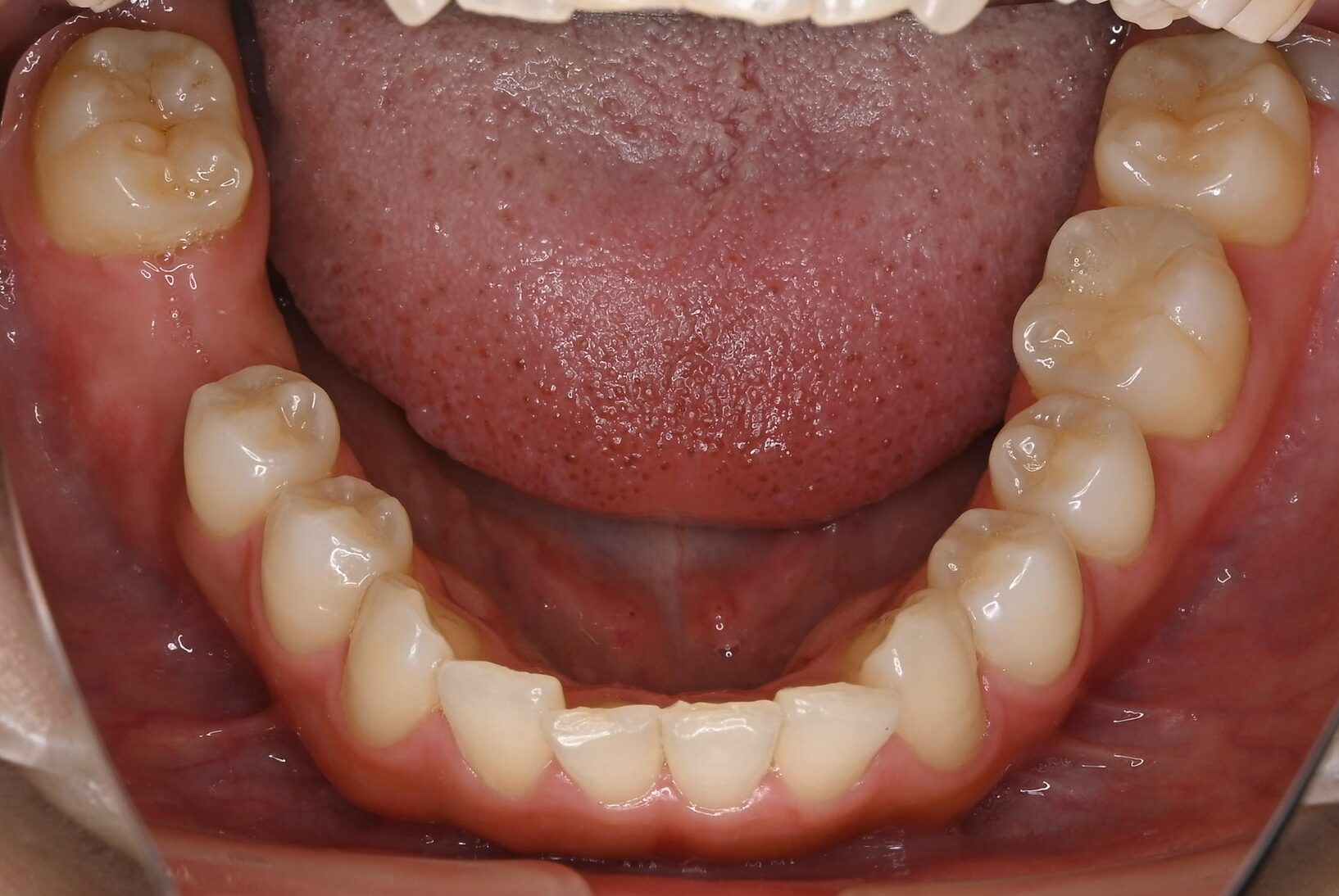 右下6番欠損です。